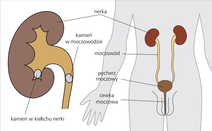 Kamica nerkowa - Choroby nerek i dróg moczowych - Choroby - Nefrologia