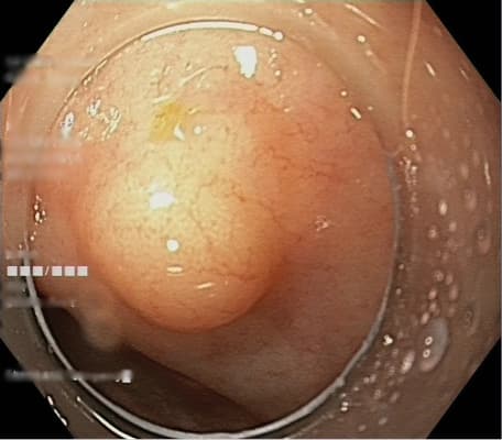 Atypical neuroendocrine neoplasm similar to hyperplastic polyp