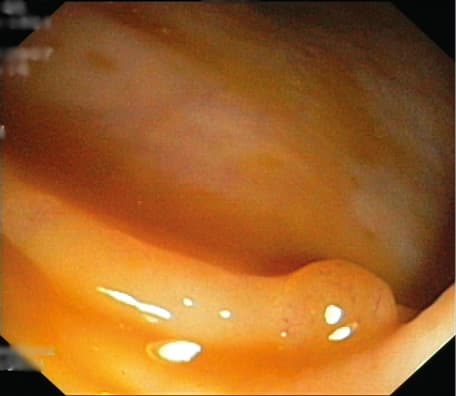 Atypical rectal neuroendocrine neoplasm with ulceration