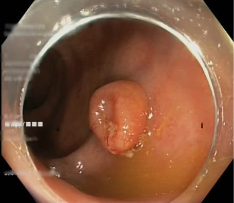 Flowchart presenting the endoscopic appearance of the lesions and the methods of resection appliedAbbreviations: see Figure 1