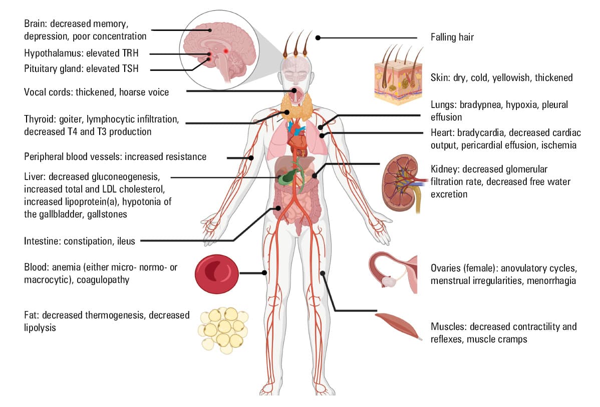Hashimoto thyroiditis: an evidence-based guide to etiology, diagnosis and  treatment