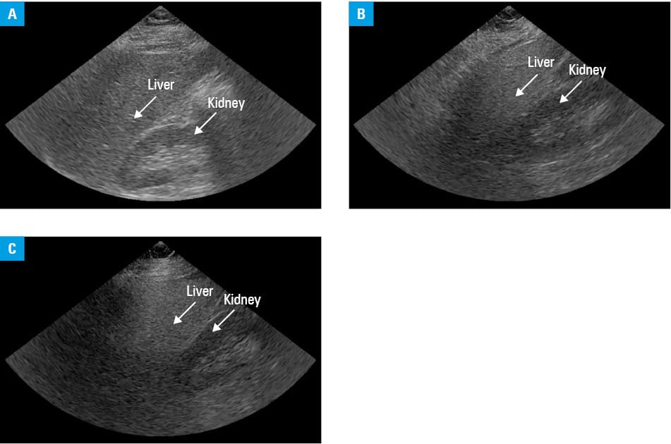 
      Example presenting the calculations of the hepatorenal index (HRI). Two regions of interest were used to outline uniform parts of the liver and the kidney to calculate average region pixel intensities and determine HRI.
    