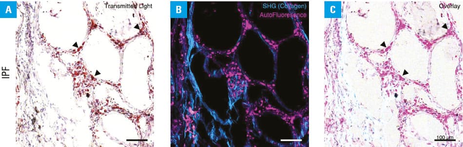 Fatty acids as inducers of profibrotic activities of lung epithelial cells, fibroblasts and macrophagesAbbreviations: ECM, extracellular matrix; ER, endoplasmatic reticulum; FA, fatty acid; M, macrophage
