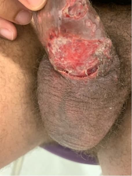 Local ulceration of the penis