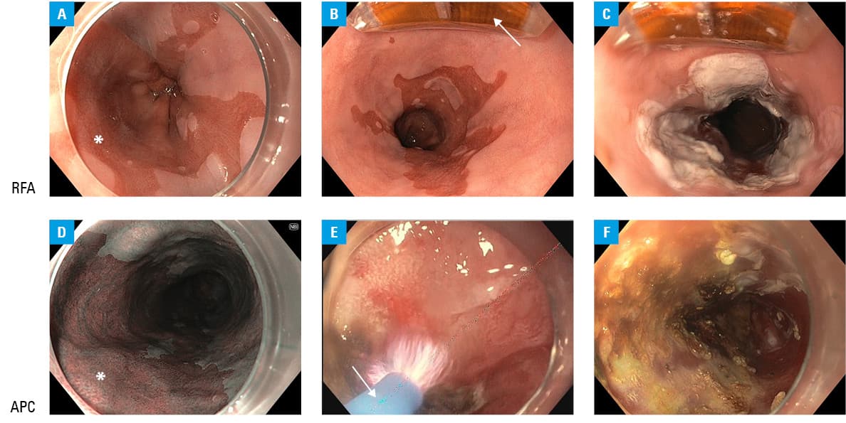 Study flowchartAbbreviations: CR-D, complete remission of dysplasia; CR-IM, complete remission of intestinal metaplasia; EAC, esophageal adenocarcinoma; h-APC, hybrid argon plasma coagulation; HGD, high-grade dysplasia; HTC, H-T. Centrum Medyczne; LGD, low-grade dysplasia; NIO, National Institute of Oncology; UHK, University Hospital in Kraków; others, see Figure 1