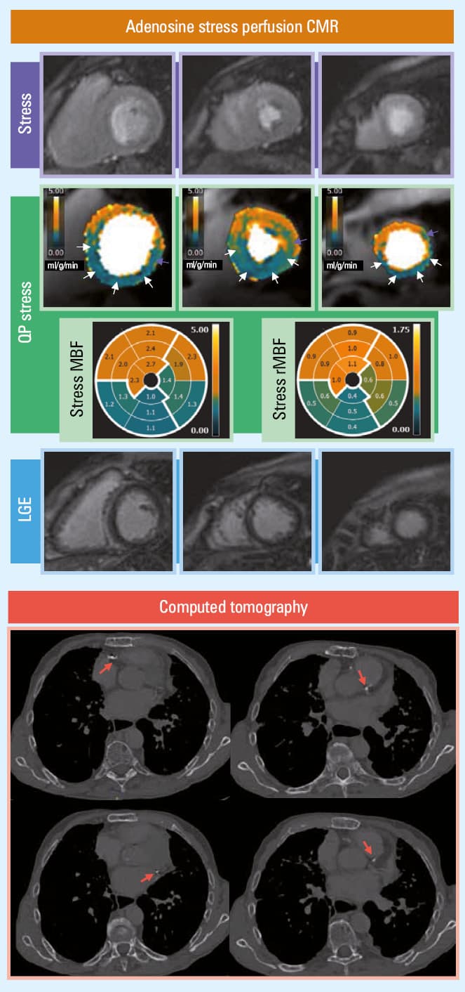Adenosine stress perfusion cardiovascular magnetic resonance imaging results of a 59-year old man with 3-vessel disease. QA identified a single perfusion defect in the basal anterior segment (LAD territory [orange arrow]) and, with less certainty (to be differentiated with a dark rim artifact), in the basal inferoseptal segment (RCA territory [white arrow]). QP stress MBF pixel maps showed extensive ischemia in the RCA territory (white arrow) which exceeded LGE (with stress MBF values reduced to 1.6 mg/ml/min), the basal and midventricular anterior / anterolateral segments (purple arrows), and partially also the apical segment. Subsequent invasive coronary angiography showed significant (>70% DS) lesions in the mid-RCA, intermediate branch, and distal LAD.Abbreviations: see Figures 1 and 2 and Table 2