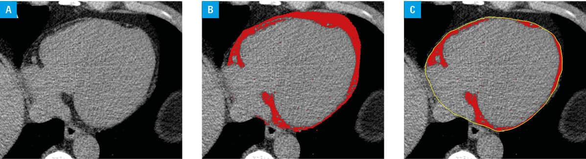 Correlations between coronary computed tomography angiography–derived low-attenuation plaque burden and noncontrast computed tomography imaging biomarkers at baseline (A–C), follow-up (D–F), and baseline-to-follow-up values (G–I)