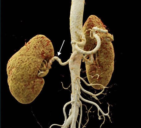 Aneurysm of the right internal carotid artery in the intracerebral section (arrow)