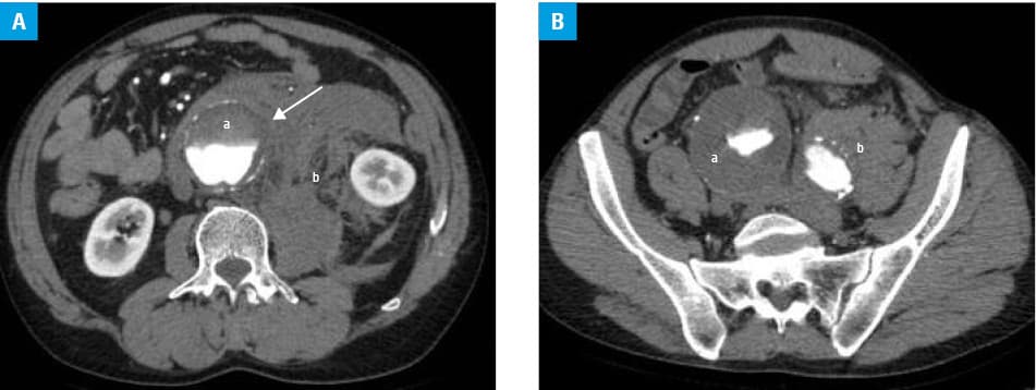 Ruptured abdominal aortic aneurysm. Axial computed tomography angiography images (A and B) show abdominal aortic aneurysm with concentric intraluminal thrombus (a) encompassing both iliac arteries. Blurring of the left proximal border (arrow) of the abdominal aneurysm sac with an extensive hyperdense zone in the surrounding tissues indicates rupture site with the formation of hematoma (b).