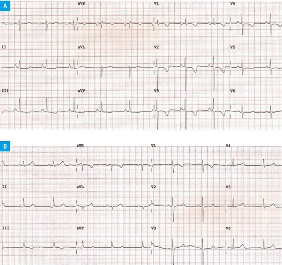 Association between the percentage changes in the pulmonary vascular resistance (PVR), mean pulmonary artery pressure (mPAP), and percentage changes in the electrocardiogram parameters (Spearman correlations were performed; regression lines were used for graphic purposes only). A – PVR and QRS axis (rho = 0.530); B – PVR and R/S ratio in lead V5 (rho = –0.636); C – mPAP and R/S ratio in V5 (rho = –0.611)