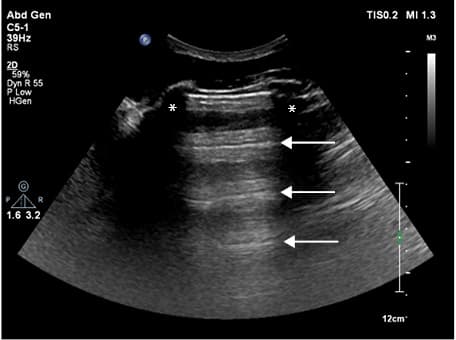 A probe placed parallel to the intercostal spaces; a visible B-line artifact (arrows): hyperechoic, arising from the pleural line, extending to the bottom of the screen