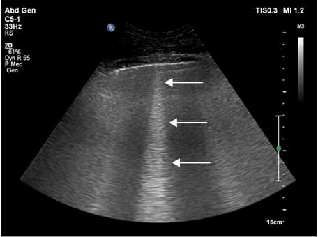 Common carotid flow on spectral Doppler ultrasonography; carotid systolic flow time, 332 ms