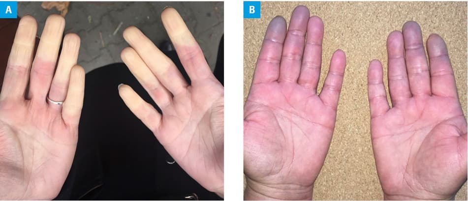 Nailfold capillary morphology: A – normal capillaries; B – abnormal results showing marked tortuosity with varied appearance, dilated and giant capillaries (magnification×200)