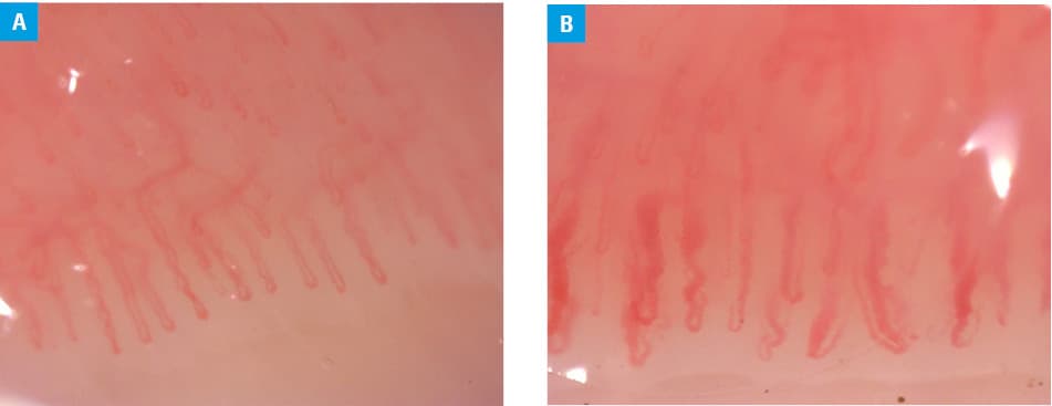 Figure 3 Morphological patterns specific to various degrees of microangiopathy in systemic sclerosis: A – early pattern; B – active pattern; C – late pattern (magnification×200).