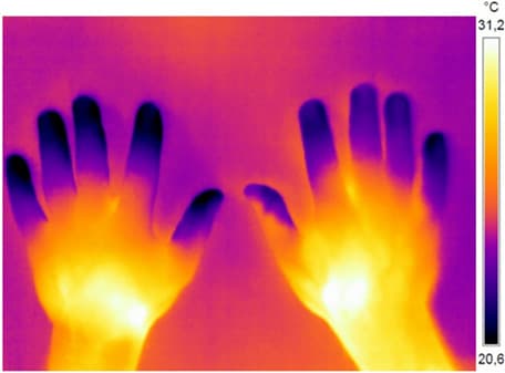 Monitoring of patients with primary Raynaud phenomenon and at risk of systemic sclerosis and other connective tissue diseasesAbbreviations: ANA, antinuclear antibody; anti-PmScl, anti-polymyositis-scleroderma; anti-RNP, anti-ribonucleoprotein; anti-SM, anti-Smith; CTD, connective tissue disease; dsDNA, anti-double stranded DNA; RP, Raynaud phenomenon, SSc, systemic sclerosis
