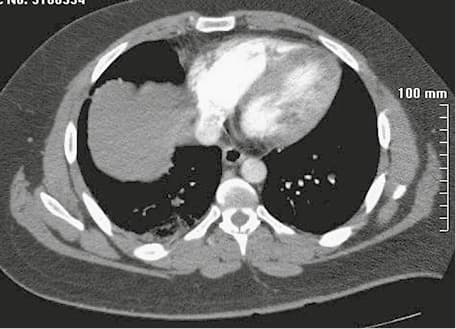 Isolated subsegmental pulmonary embolism: computed tomography pulmonary angiography showing intraluminal filling defect in the right lower lobe (arrow) and pleural effusion in both sides