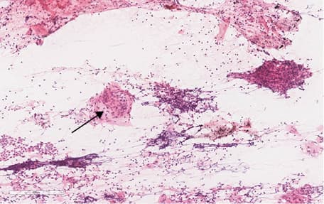 Cell block section of a lymph node sample from a patient with sarcoidosis showing a fragment of granuloma formed of epithelioid histiocytes with an asteroid body (arrow) (permission and image courtesy of Department of Pathology, Pulmonary Hospital, Zakopane, Poland)