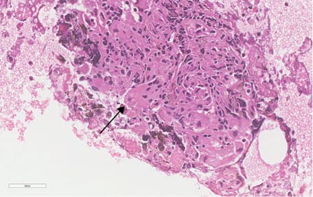 Flowchart of patients enrolled in the studyAbbreviations: CUS-b-NA, combined ultrasound-guided needle aspiration; EBB, endobronchial biopsy; EBUS-TBNA, ultrasound-guided transbronchial needle aspiration; EUS-b-FNA, endoscopic ultrasound fine-needle aspiration; TBLB, transbronchial lung biopsy; TBLC, transbronchial lung cryobiopsy
