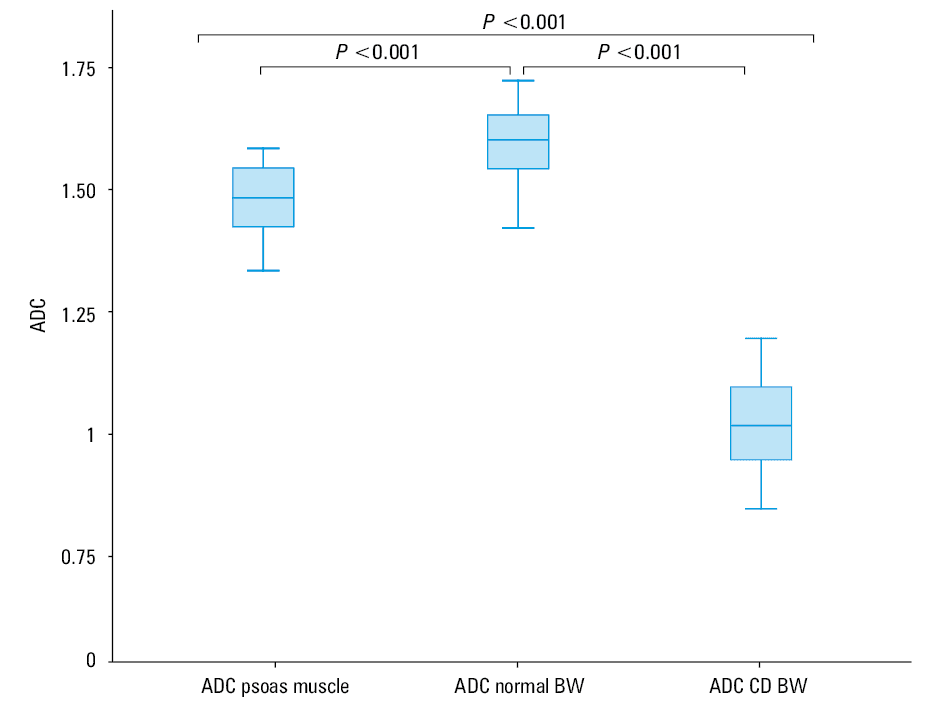 Receiver operating characteristic curve analysis of cutoff values for apparent diffusion coefficient between patients with Crohn disease and controls according to Copenhagen diagnostics criteria (A) and magnetic resonance index of activity (B)Abbreviations: AUC, area under the curve