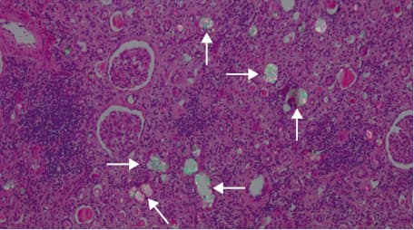 Follow-up of estimated glomerular filtration rate (eGFR) in patients with primary hyperoxaluria type 1 (PH1; F1–F9), PH2 (F10.1, F10.2), and PH3 (F11–F15). Patient F6 who developed end-stage renal disease at the age of 63 years is not shown.