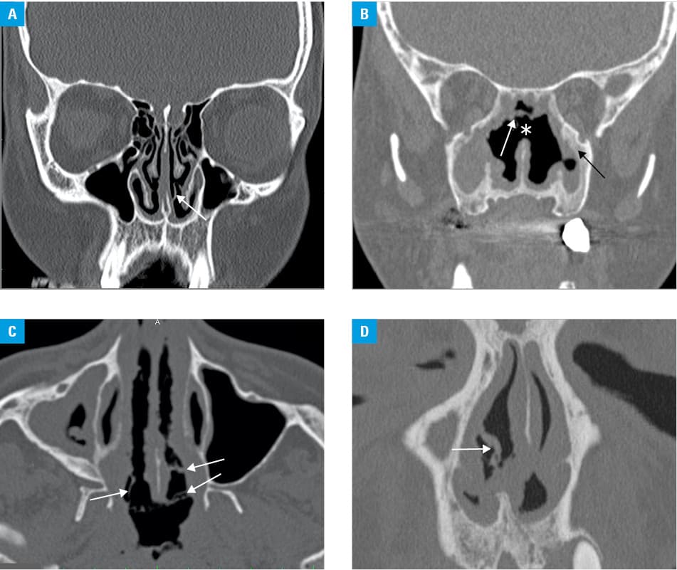 Receiver operating characteristics (ROC) curve reflecting the capability of the presence of nasal strands on CT to distinguish between patients with granulomatosis with polyangiitis and patients with chronic rhinosinusitis