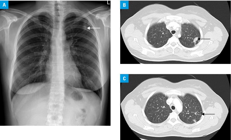 Imaging findings in a 62-year-old nonsmoking woman with a 3-month history of cough and weight loss who received chemotherapy for salivary gland lymphoma. Lung lesions appeared during chemotherapy. The diagnosis of tuberculosis was established based on lung specimen analysis (marginal resection). Histological examination of the station 7 lymph node specimen showed granulomas and caseous necrosis (microbiological tests were not performed). The patient had not undergone any examination for tuberculosis previously. A – chest radiograph (posteroanterior view) showing irregular patchy consolidations (possibly inflammatory lesions) in the middle zone of the right lung (arrow); diffuse reticular and linear opacities in the lower and, of lesser extent, middle zones, and widening of the right mediastinum; B, C – computed tomography (lung window, axial plane) showing subpleural consolidations in the posterior segment of the right upper lobe (arrow) (possibly organizing pneumonia), and reticular and linear opacities with traction bronchiectases (arrow) indicating interstitial fibrosis in the lung bases; D–F – computed tomography (mediastinal window, axial plane) showing enlarged mediastinal lymph nodes—upper paratracheal, lower paratracheal, para-aortic, subcarinal, and hilar (arrows)