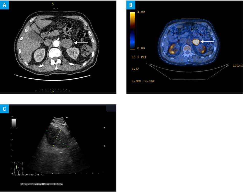 Receiver operating characteristic curve showing the sensitivity and specificity of computed tomography (Hounsfield units) for the assessment of left adrenal metastases