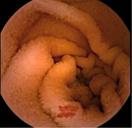 Recommended diagnostic workup of suspected obscure gastrointestinal bleedingAbbreviations: CTE, computed tomography enterography; MRE, magnetic resonance enterography; VCE, video capsule endoscopy