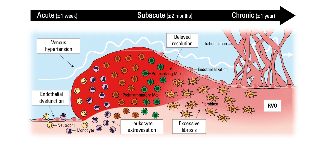 Interplay of pathogenic processes leading to post-thrombotic syndrome
Abbreviations: CAM, cell adhesion molecule; CDT, catheter-directed thrombolysis; ECT, elastic compressive therapy; Esel-inh, E-selectin inhibitor; ET1-inh, endothelin-1 inhibitor; others, see Figure 1