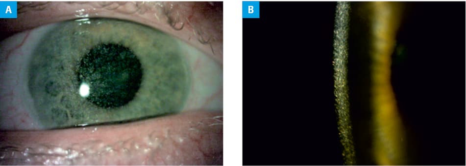 Follow-up of linear growth in Polish patients with infantile nephropathic cystinosis (patients F12.1 and F12.2, accordingly treated with oral cysteamine are highlighted in red)