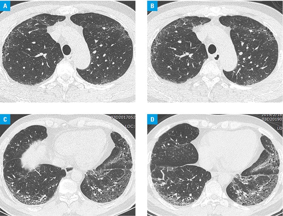 Different chest computed tomography features in 151 patients with primary Sjögren syndrome with or without pulmonary fibrosis