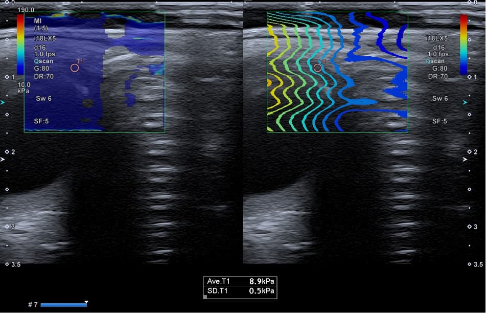 Elastographic image of the lacrimal gland in a patient without primary Sjögren syndrome (control group)