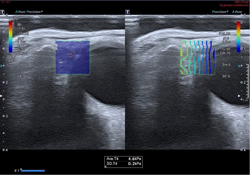 Receiver operating characteristic analysis of the diagnostic accuracy of lacrimal gland elastography (the mean result of right and left lacrimal gland elastography) for the detection of primary Sjögren syndrome