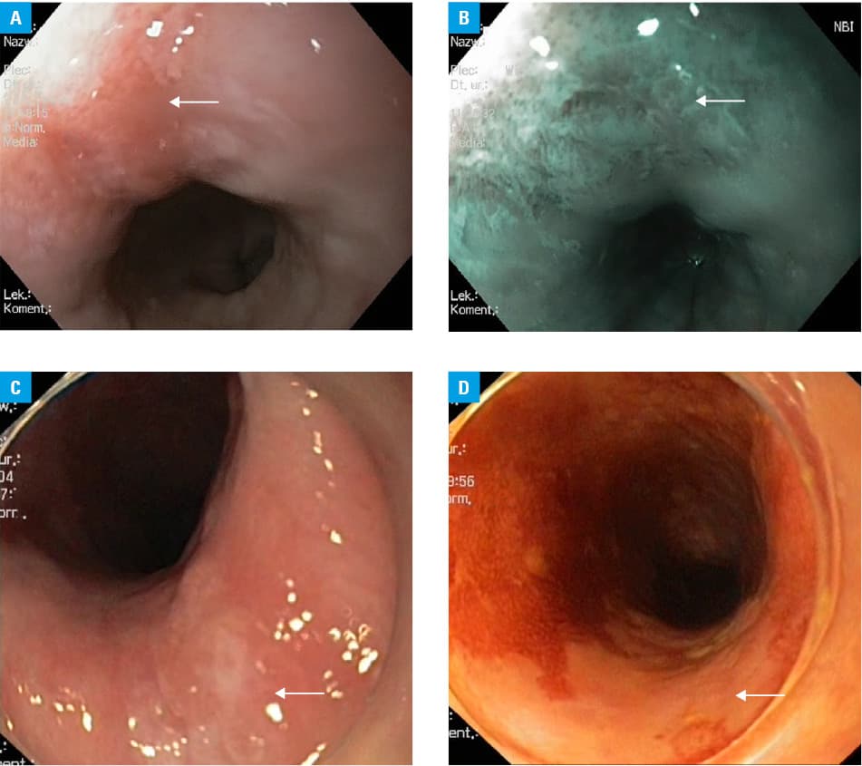 Overview of the study designa Unequal allocation to the randomization groups results from stratification by primary cancer site and sexAbbreviations: GI, gastrointestinal; NBI, narrow-band imaging