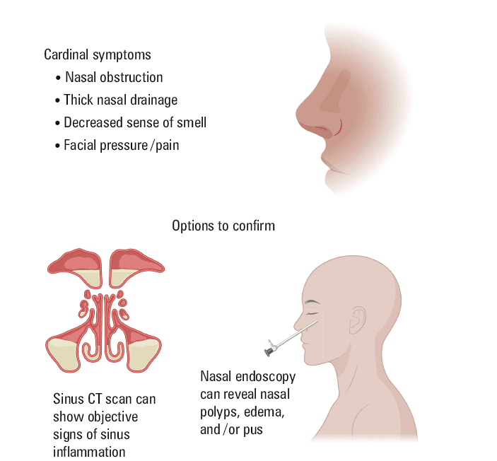 Classification of chronic rhinosinusitis (CRS). The disease can be categorized as CRS with or without nasal polyps, and further subcategorized into various underlying disorders that fit either category. Disease subtyping is especially important for patients who do not adequately improve after initial treatment.Abbreviations: CF, cystic fibrosis; EGPA, eosinophilic granulomatosis with polyangiitis; GPA, granulomatosis with polyangiitis; NERD, nonsteroidal anti-inflammatory drug–exacerbated respiratory disease