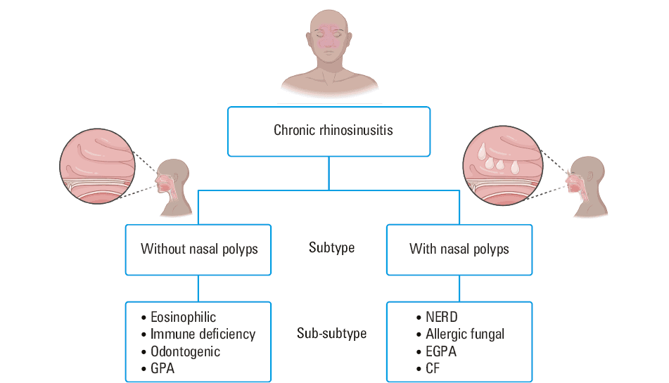 An overall treatment approach to CRSwNP, including most of the key possible treatment options. The boxes are connected by arrows which follow a suggested path; however, each patient’s presenting circumstances are different (eg, symptom severity, prior treatment attempts), and it is important to use a shared decision-making approach given the conditional nature of guideline suggestions for different management options.a INCS delivery methods with the best effectiveness and safety evidence are sprays, rinses, and exhalation delivery systems.b Biologic drugs with the best effectiveness and safety evidence are dupilumab, mepolizumab, and omalizumab.Abbreviations: CRSWnp, chronic rhinosinusitis with nasal polyps; CFTR, cystic fibrosis transmembrane conductance regulator; ESS, endoscopic sinus surgery; IL, interleukin; NSAID, nonsteroidal anti-inflammatory drug; SCS, systemic corticosteroid; others, see Table 1