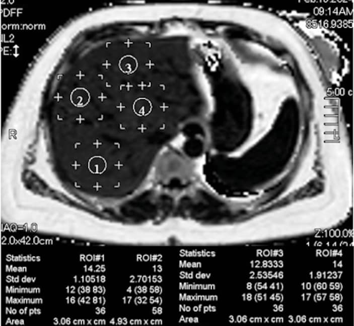 Evaluation of the liver fat content with the attenuation imaging algorithm implemented on the Aplio i800 ultrasound system (Canon Medical Systems, Otawara, Tochigi, Japan) in a 54-year-old woman with steatotic liver disease. The attenuation coefficient is 0.99 dB/cm/MHz, indicating severe steatosis. The field of view (the larger box) is color-coded; the trapezoid with yellow borders is the measurement box.