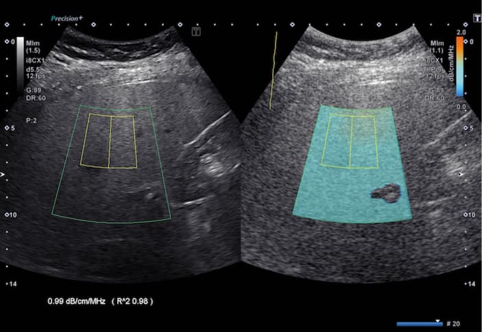 Evaluation of the liver fat content with the ultrasound-derived fat fraction (UDFF) algorithm implemented on the Sequoia ultrasound system (Siemens Healthineers, Erlangen, Germany) in a 63-year-old man with steatotic liver disease. The UDFF algorithm combines the attenuation coefficient and backscatter coefficient data, and the results are presented as percentages. In this case, the value is 15%, indicating moderate steatosis.