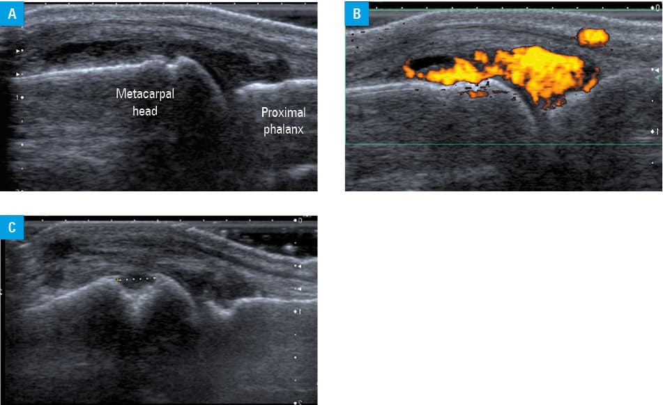 Representative ultrasound (US) images of enthesitis in a patient with a new diagnosis of entheropatic arthritis who complained of knee and elbow pain and restricted range of movements; A – longitunal view at the apex of the patella showing thickening and decreased echogenicity of the patellar ligament enthesis; B – power Doppler US showing markedly increased vascularity indicating active enthesitis; C, D – longitudinal view at the distal triceps and olecranon showing thickening of the enthesis and irregular cortical outline of the olecranon indicating a presence of enthesophytes and erosions