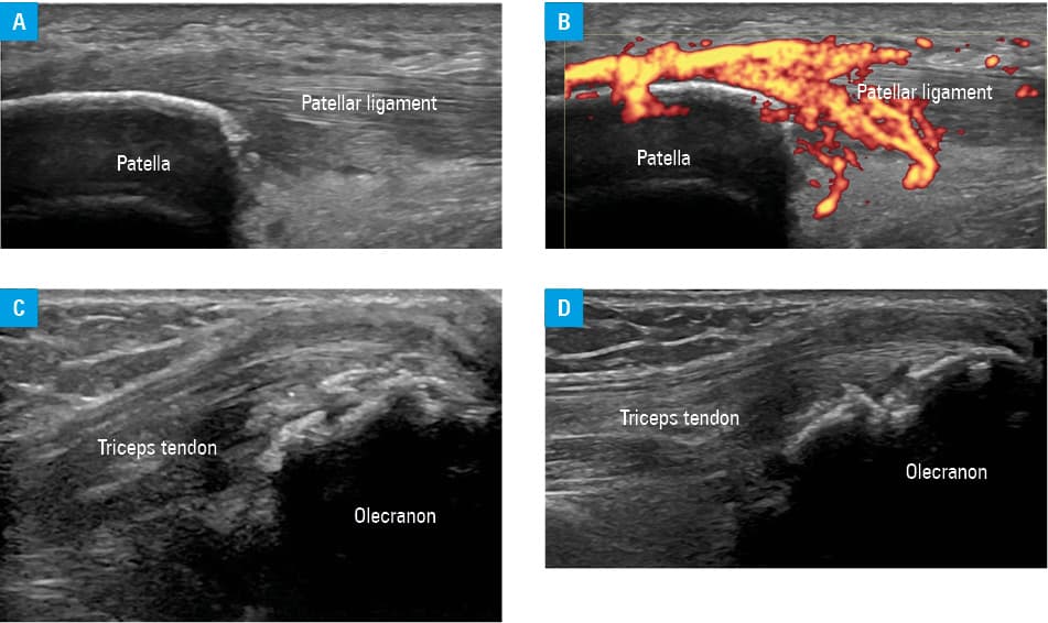Representative ultrasound (US) images of inflammatory and structural lesions at hand joints in patients with psoriatic arthritis; A – dorsal longitudinal view of the PIPJ showing thickening of the ECS and synovial hypertrophy at the distal recess of the PIPJ (asterisk); B – power Doppler US showing increased signal in the synovial tissue and at the ECS indicating active synovitis and enthesitis; C – dactylitis; palmar longitudial view of the middle finger showing synovial hypertrophy at the volar recess (asterisk) of the PIPJ, along with swelling and increased vascularity of subcutaneous tissue; D – interphalangeal joint in a longitudinal view over the collateral ligament showing an irregular cortical outline as a sign of juxta-articular periosteal reactionAbbreviations: ECS, extensor central slip; FD, flexor digitorum; PIPJ, proximal interphalangeal joint