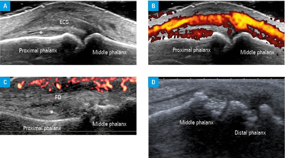Ultrasound elementary lesions indicative of gout; A – dorsal longitunidal view at the metacarpophalangeal joint showing a double contour sign (arrow); B – dorsal longitudinal view of the metacarpal bone showing a large tophus adjacent to the extensor digitorum tendon (asterisks); C – lateral aspect of the PIPJ in a longitudinal view. The asterisk marks MSU deposits within the collateral ligament. D – IPJ in a dorsal longitudinal view showing MSU deposits within the synovial tissue of the IPJ (asterisk)Abbreviations: IPJ, interphalangeal joint; MSU, monosodium urate; others, see Figure 3
