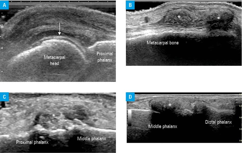 Ultrasound images of calcium pyrophosphate (CPP) deposition disease; A – transverse view of the femoral condyle. Arrows indicate the external outline of the cartilage. CPP deposits are seen as bright speckles in the central layer of the hyaline cartilage. B – medial meninscus (arrow) seen in a longitudinal view over the medial knee compartment. Bright speckles of CPP deposits whithin the menisci are visible. C – longitudinal view of the ulnar aspect of the wrist showing triangular cartilage (arrow) with bright speckles of CPP deposits