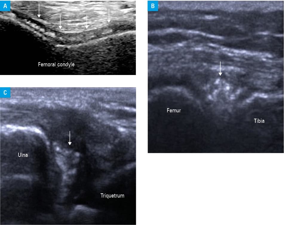 Calcific periarthritis of the wrist. A 43-year-old woman attended the emergency department a couple of times over the course of a week with worsening pain and swelling of the left wrist. The patient was referred to a hand surgeon who carried out an ultrasound examination of the wrist planning to perform guided aspiration for culture. A – radiogram of the wrist showed density at the dorsal aspect of the carpus, likely representing a calcified ganglion cyst; B – transverse view of the dorsal aspect of the wrist showed subcutaneous tissue edema (v) and low-grade effusion in the second and third extensor compartments; C – longitudinal view of the dorsal aspect of the wrist showed well-circumscribed, izoechoic lesion (asterisk) with no acoustic shadow, suggesting crystal deposition; D – washout of the lesion with a pale sediment, wich turned out to be masses of amophic calcium hydroxyapatite.Symptoms settled entirely within 7 days after aspiration of the lesion, on treatment with etoricoxib.Abbreviations: ECRB, extensor carpi radialis brevis; ECRL, extensor carpi radialis longus; EDC, extensor digitorum communis; EPL, extensor pollicis longus