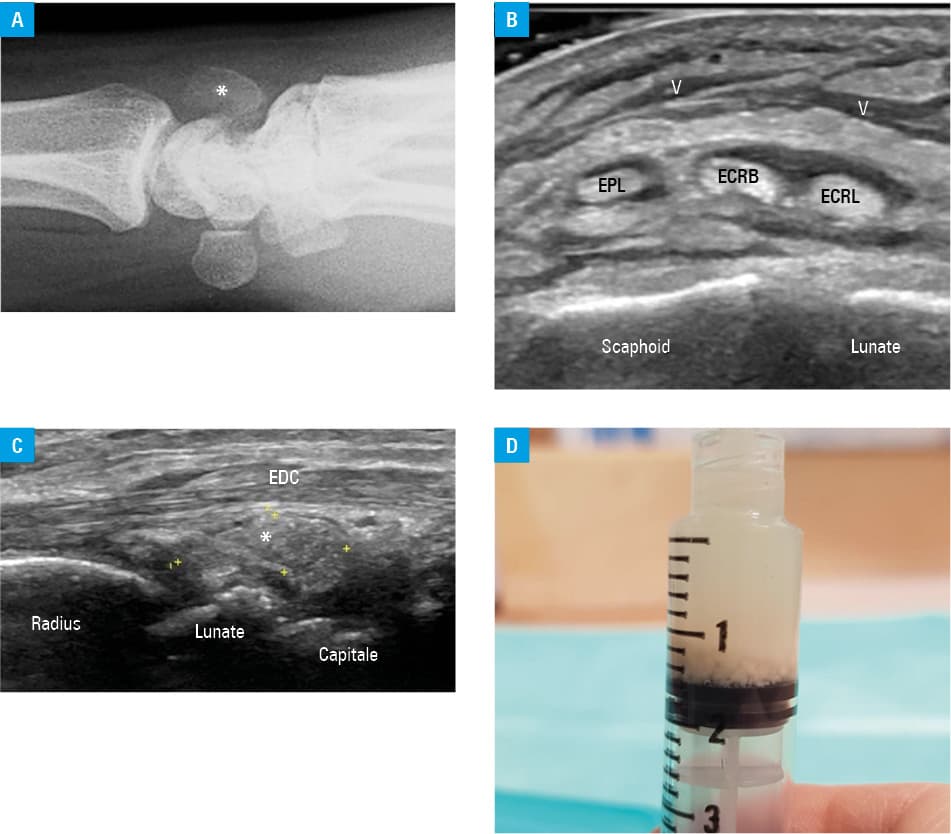 Ultrasound images of a halo sign in a patient with giant cell arteritis; A – longitudinal view of the superficial temporal artery with the use of color Doppler. The blue signal indicates blood flow in the artery and serves as a contrast to the thickened and hypoechoic (dark) arterial wall, which forms a “halo” around the vessel lumen. B – axillary artery with markedly thickened intima-media and narrowing of the lumen