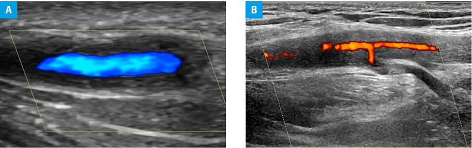 Representative ultrasound images of the submandibular gland in primary Sjögren syndrome. The gland was scanned using a linear probe (8–12 MHz). The parenchyma of the normal gland (A) is smoothly echogenic and devoid of hypoechoic or anechoic areas, in contrast to grade 3 changes (B and C), where the parenchyma is inhomogeneous with the presence of many hypoechoic and anechoic (dark areas) through the gland. The presence of Doppler signal indicates vascular inflammation (D).