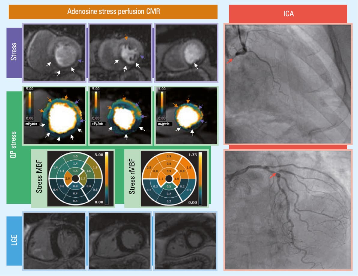 Diagnosis of ischemia according to qualitative assessment of conventional grey-scale first-pass stress perfusion images and quantitative perfusion color pixel map analysisAbbreviations: see Figure 1
