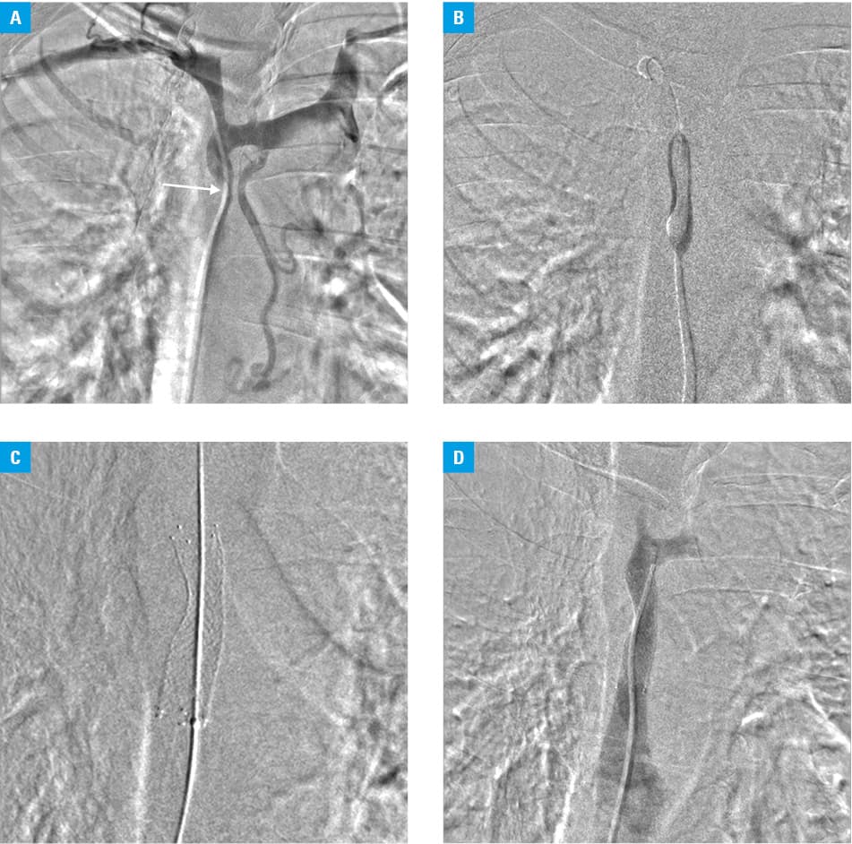 A – venography presenting superior vena cava obstruction at the right brachiocephalic vein outflow site (arrow); B – venography after implantation of a 12 mm × 60 mm self-expandable stent showing residual stenosis below the stent (arrow); C – overlap implantation of a second 12 mm × 60 mm self-expandable stent with good angiographic results and residual stenosis (about 10%) at the superior vena cava outlet to the right atrium (arrow)