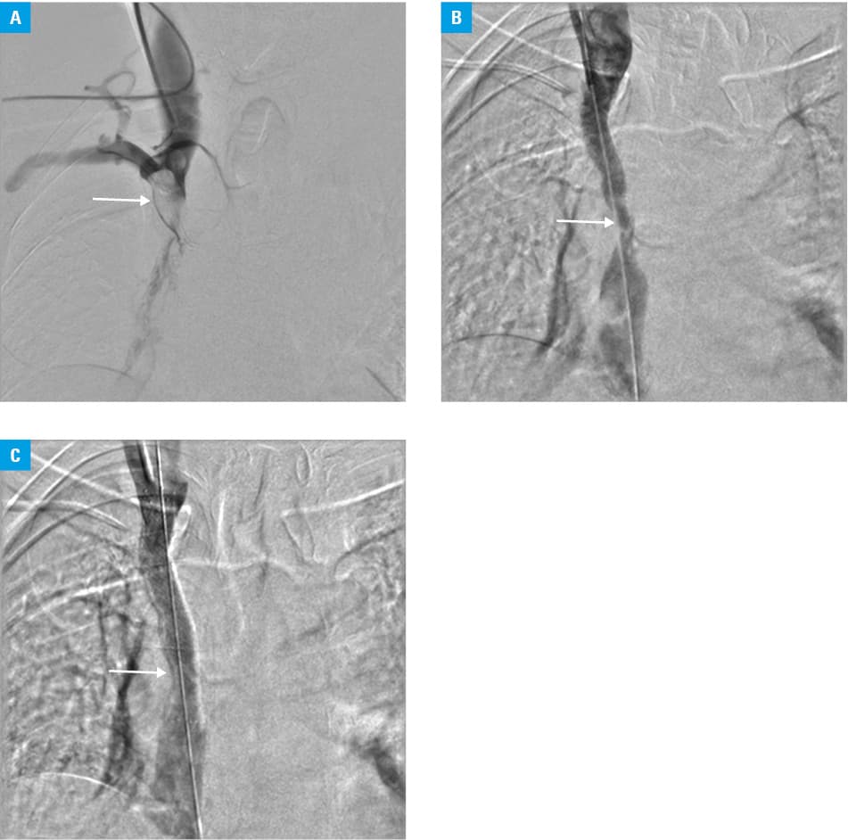 Changes in the superior vena cava (SVC) pressure before and after stent implantation. Whiskers indicate the minimal and maximal values, boxes indicate the interquartile range, and the line in the middle of each box represents the median.